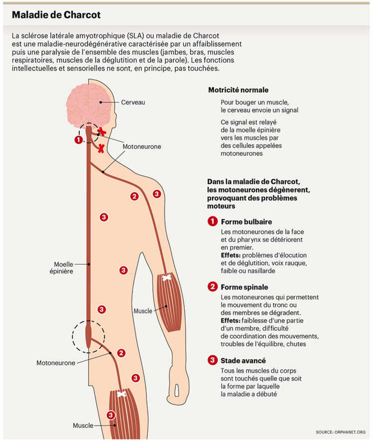 Tout savoir sur la maladie de Charcot