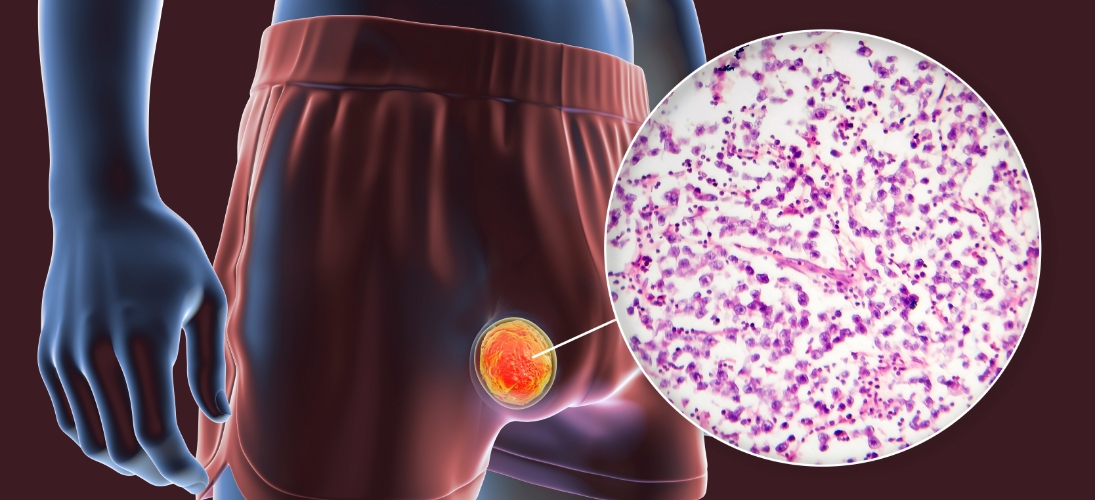 Tout savoir sur le Cancer du Testicule