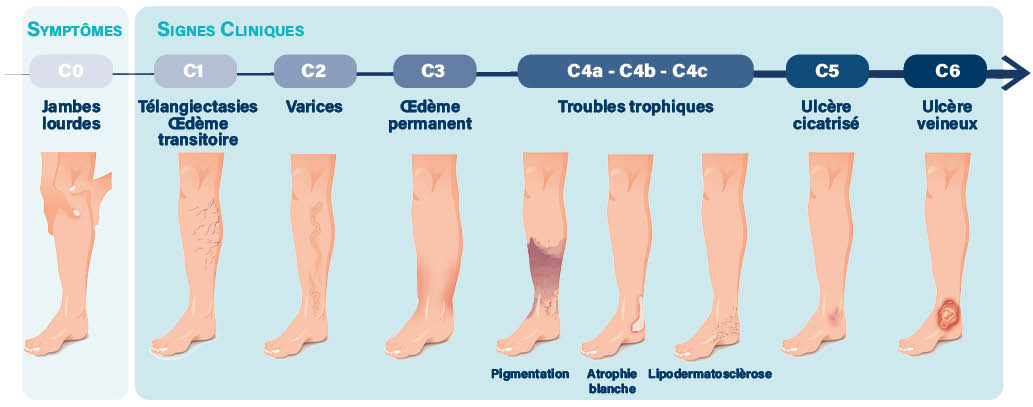 Comprendre l'insuffisance veineuse : causes et solutions