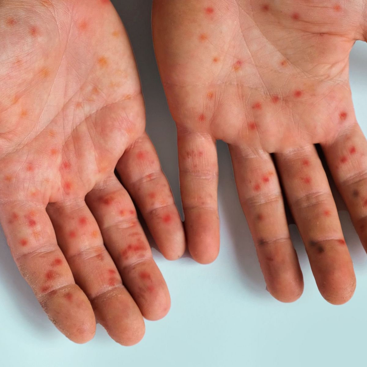 Premier cas de virus mpox à La Réunion : alerte sanitaire